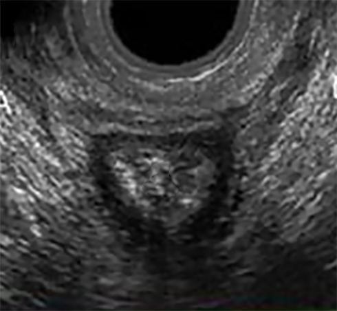 endovaginalt ultraljud