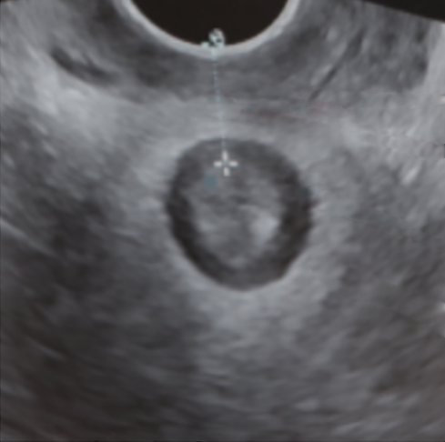 vaginalt ultraljud
