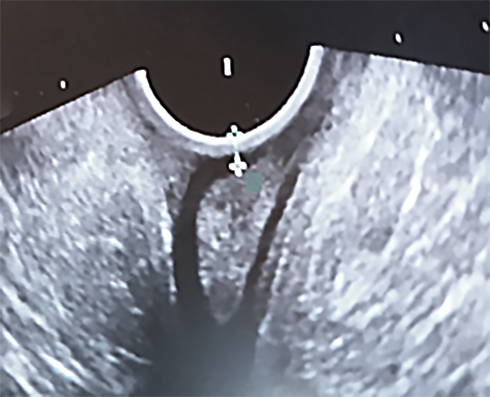 vaginalt ultraljud bristning